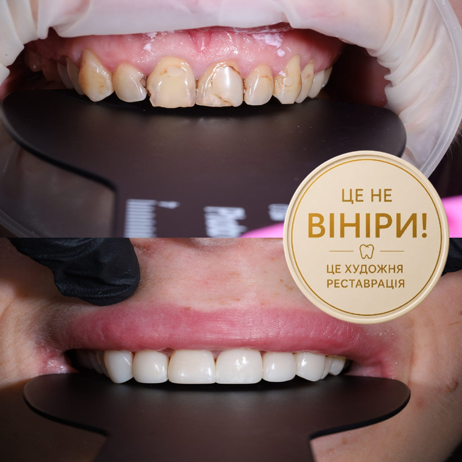 Естетична робота Dr. HURTOVA Estetic Dent - приклад відновлення посмішки